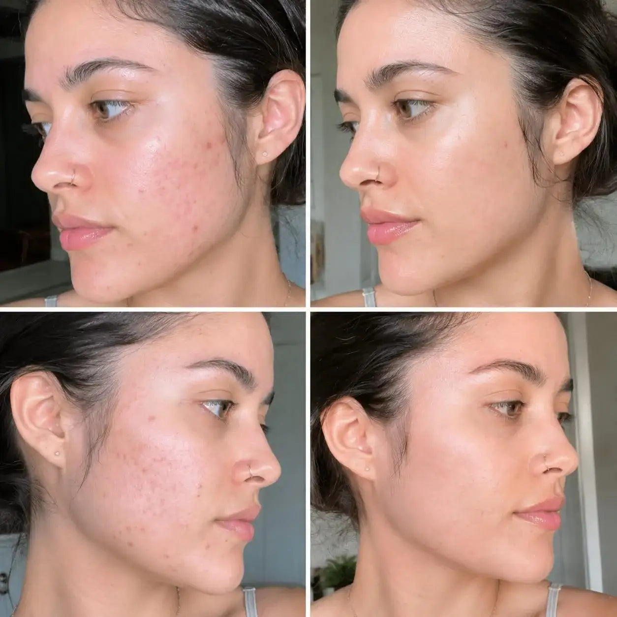 Antes y después de piel con acné y manchas post-acné, mejoría visible con rutina personalizada