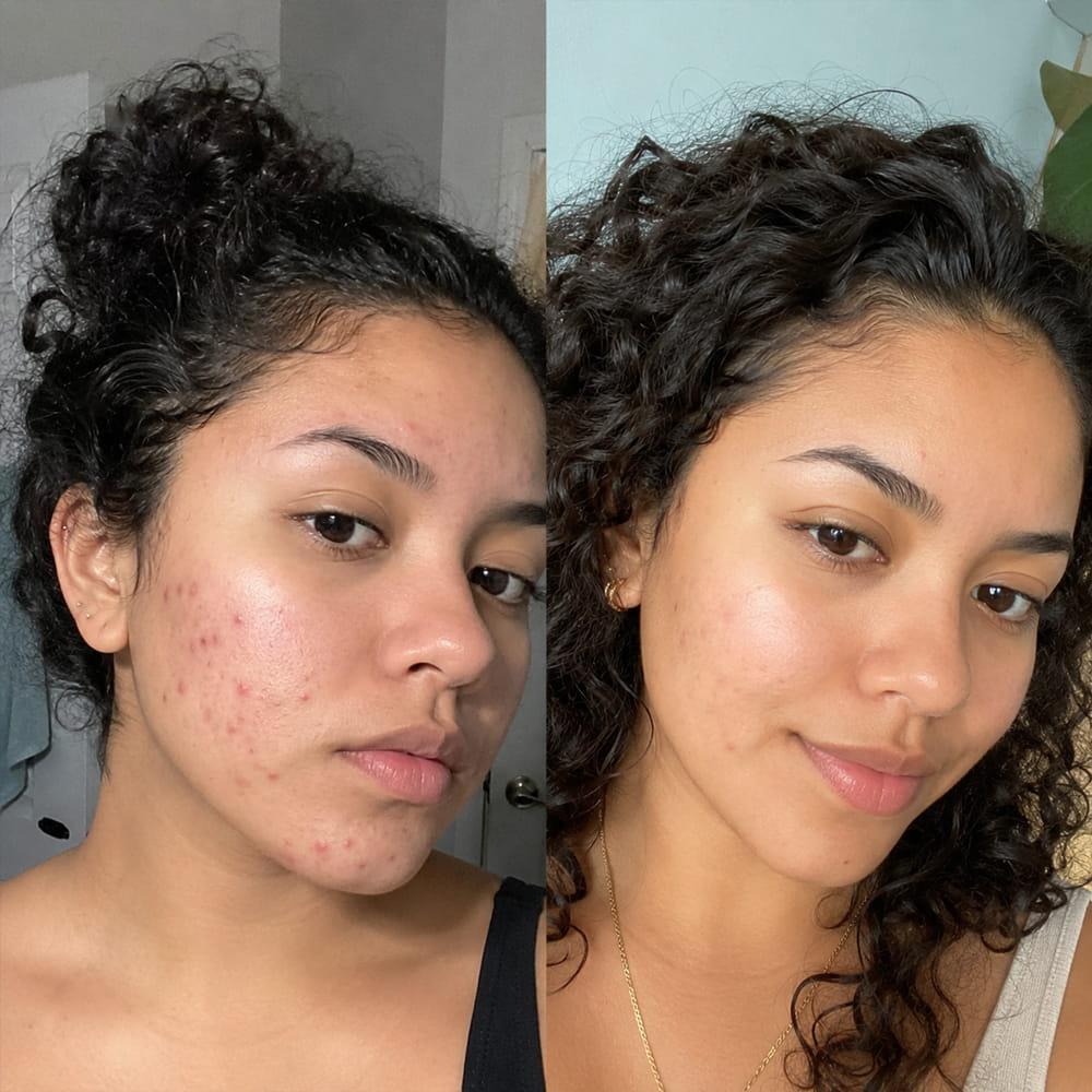 Antes y después de piel con acné y manchas post-acné, mejoría visible con rutina personalizada