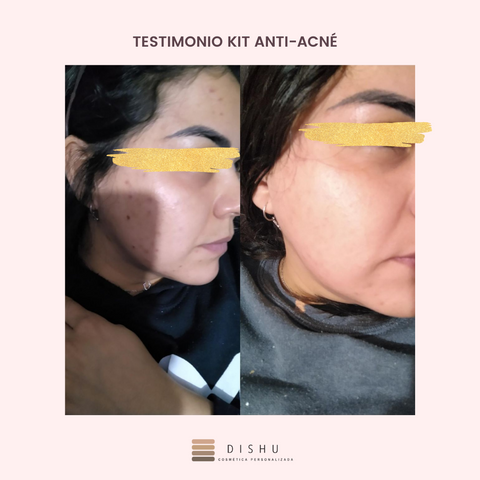 Kit Antiacné